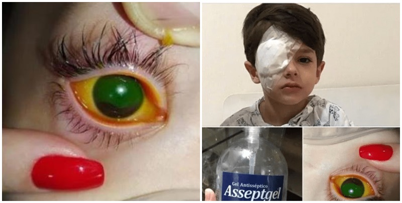 Criança tem a córnea queimada em acidente álcool gel