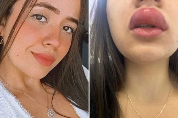 Jovem é atacada por lacraia enquanto dormia e fica deformada