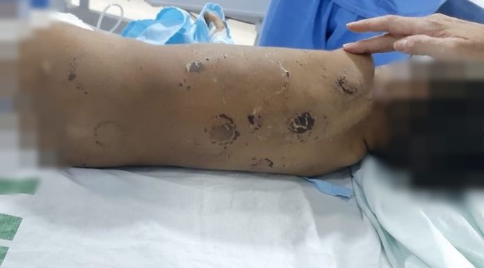Criança é internada com costelas quebradas, marcas de mordidas e suspeita de traumatismo