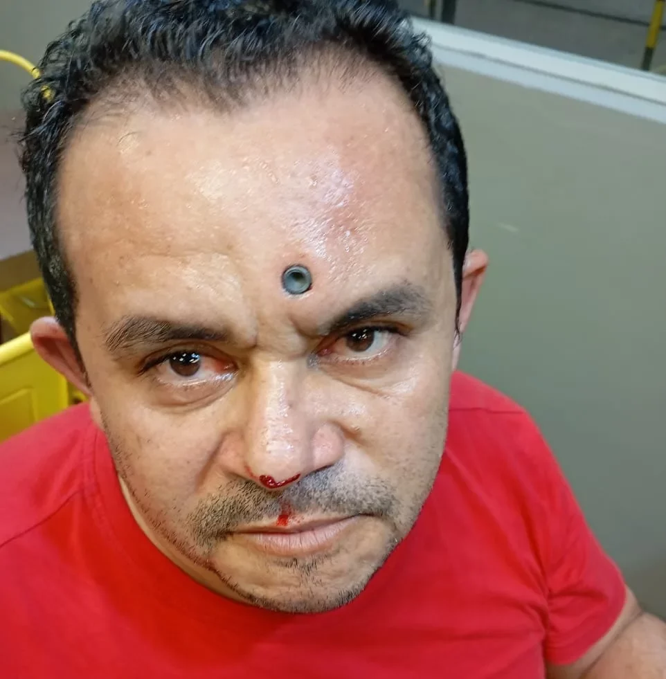 Homem leva tiro na testa e sobrevive