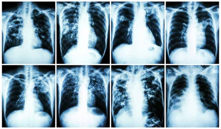 Campanha de combate à Tuberculose começa nesta segunda-feira (21)