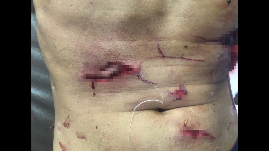 Pescador sofre ataque de crocodilo