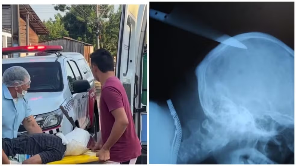 Homem fica com faca cravada na cabeça após discussão em Monte Alegre