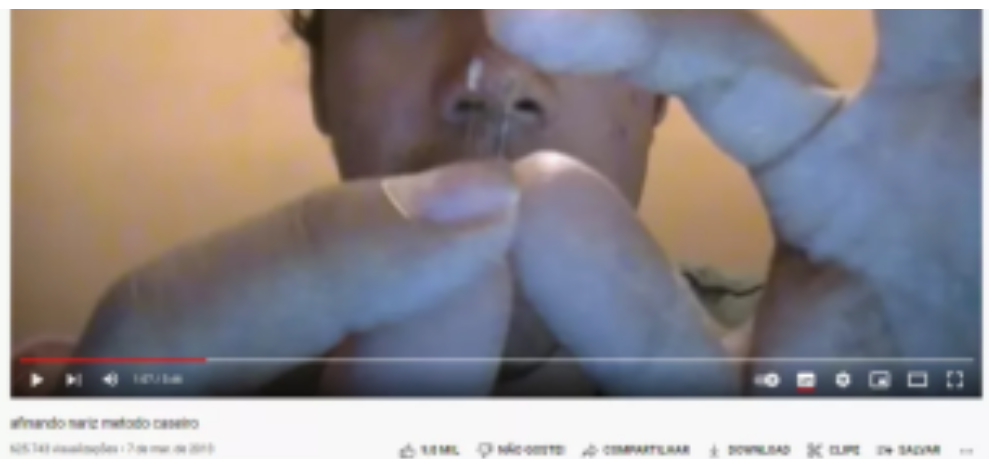 Homem é internado ao tentar fazer rinoplastia em si mesmo após ver vídeo no YouTube