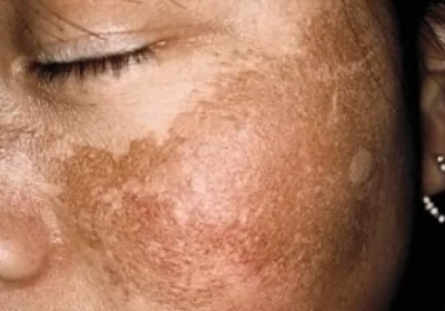 Melasma 90% dos casos acontecem em mulheres saiba como se prevenir e o tratar