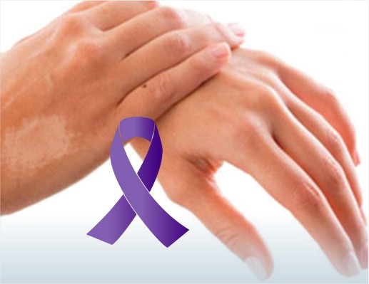 Campanha vai intensificar o combate e a prevenção da Hanseníase