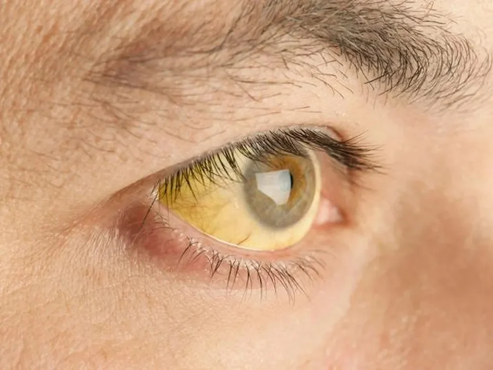 Alerta de Febre-Amarela em Breves, no Marajó: 40 Casos Confirmados e 7 Mortes