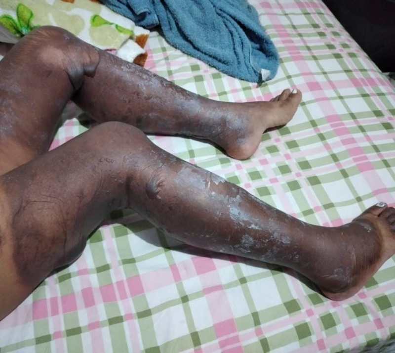 Mulher sofre queimaduras nas pernas ao preparar sabão caseiro