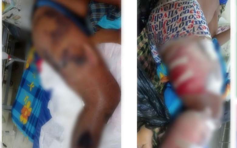 Homem é internado em estado grave após ser picado por cobra em Outeiro