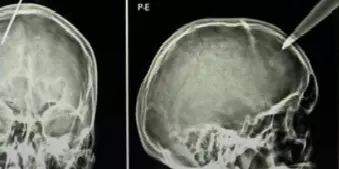 Adolescente fica ferido após ter faca cravada na cabeça durante discussão com irmão em Portel, no Marajó