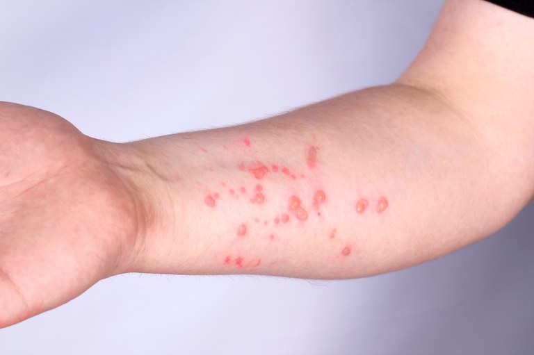 Prefeitura de Parauapebas esclarece que o município não tem nenhum caso suspeito de Mpox