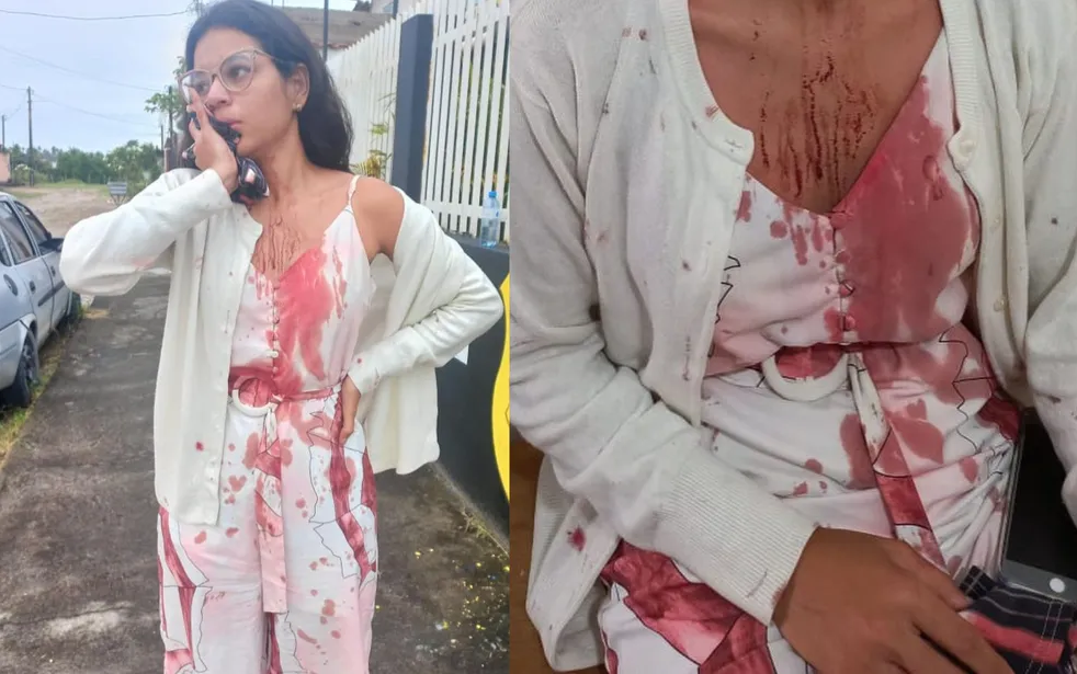 Estudante tem rosto cortado enquanto dormia durante viagem em ônibus; vítima levou 18 pontos