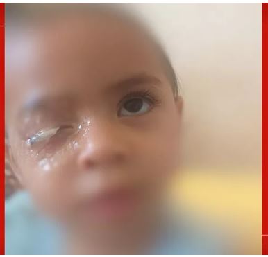 Menina de 2 anos vai parar no hospital após grudar olho com super cola