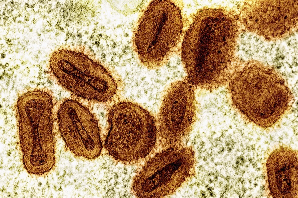 Prefeitura de Belém confirma morte de paciente por MPOX