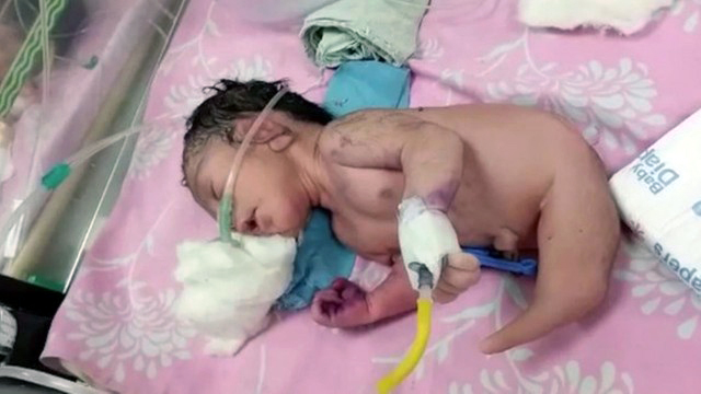 Síndrome rara: Bebê nasce com ‘rabo de sereia’