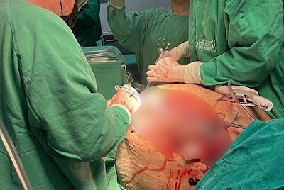 Mulher que teve tumor de 46 kg removido morre 11 dias após cirurgia