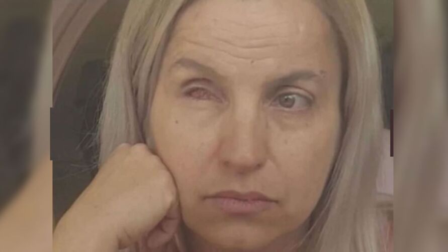 Empresária conta que olho “derreteu” após cirurgia plástica