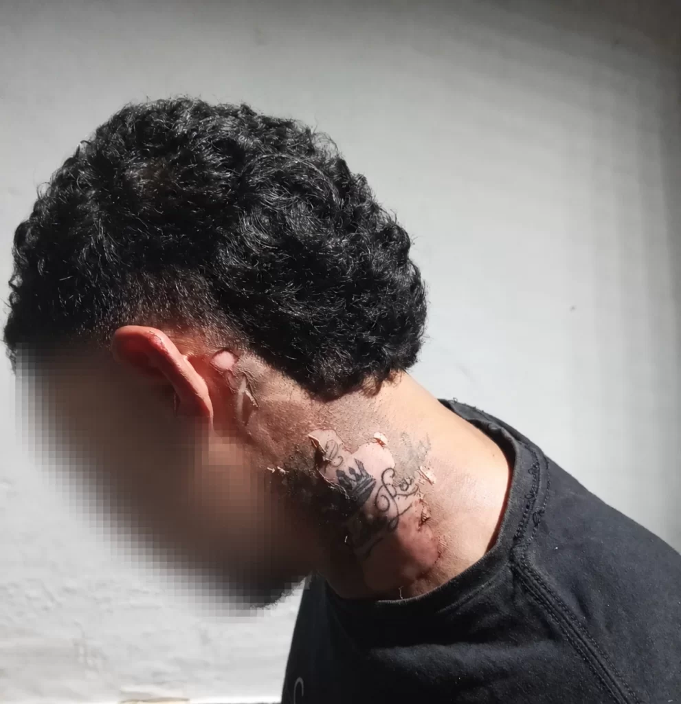 Homem sofre queimaduras após ser atingido por óleo quente em Parauapebas